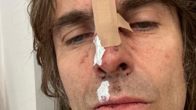liam-gallagher-pateix-un-accident-d’helicopter-i-es-trenca-el-nas liam-gallagher-pateix-un-accident-d’helicopter-i-es-trenca-el-nas
